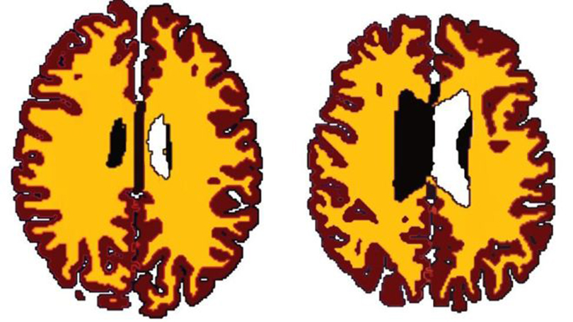 brainobesity