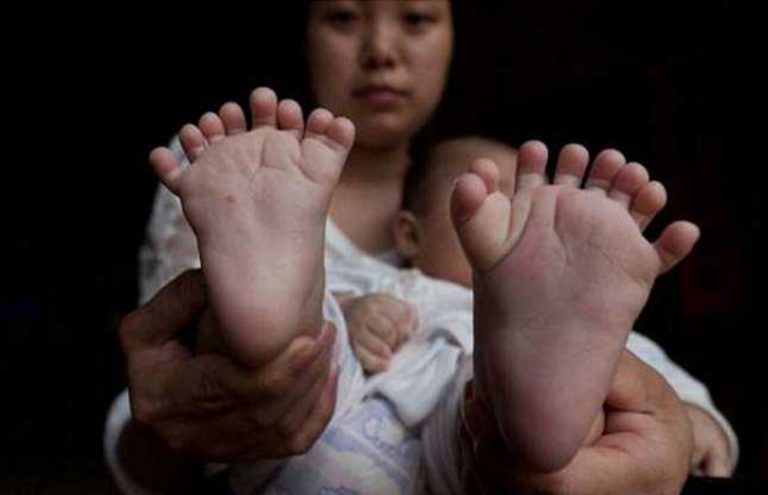 यो बच्चाको हातखुट्टामा छन् ३१ औँला