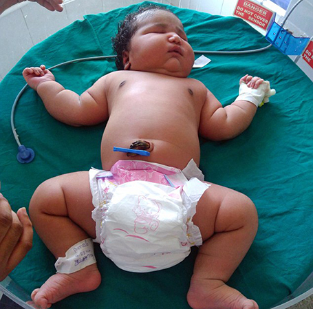 भारतमा जन्मियो ‘संसारकै सबैभन्दा ठूलो’ शिशु