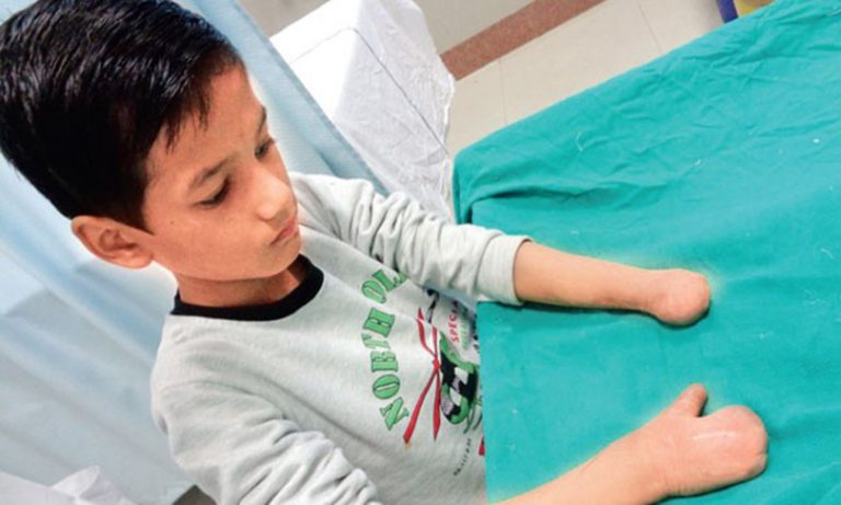 १० वर्षे नेपाली बालकका खुट्टाका औंला हातमा प्रत्यारोपण