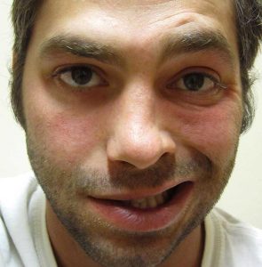 जाडोमा मुख बाङ्गो हुने समस्या : कसरी जोखिने ?