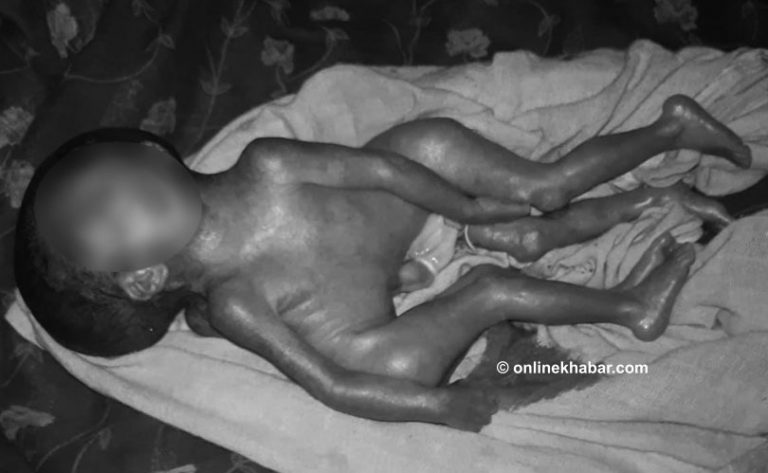 कैलालीमा चार हात, चार खुट्टा र दुई मेरुदण्ड भएको बच्चा जन्मियो