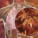 बाजुरामा क्षयरोगबाट पाँच वर्षमा १८ जनाको मृत्यृ