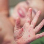 सर्लाहीको मलङ्गवामा दादुरा सङ्क्रमण फैलियो