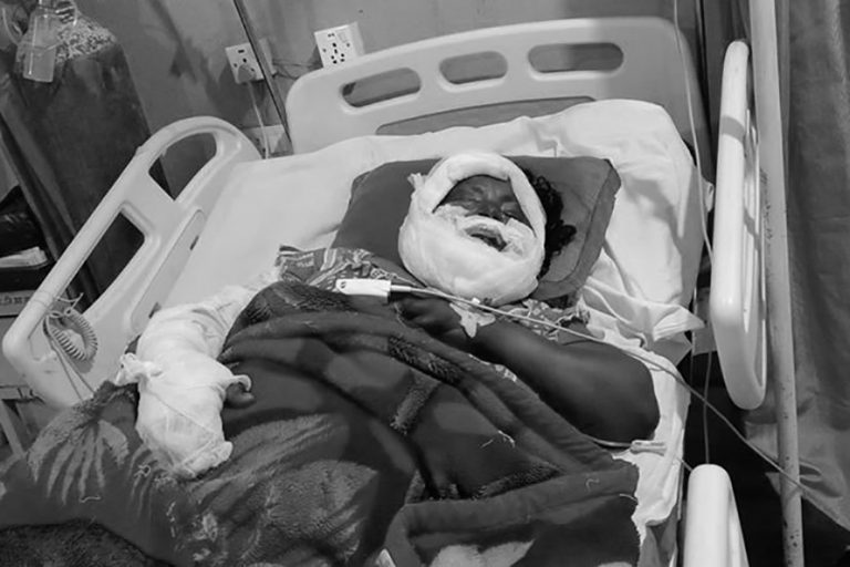प्रत्येक प्रदेशमा जलन उपचार विभाग, वीरमा पनि विस्तार