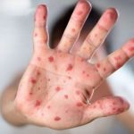 बागलुङको ढोरपाटनमा सात जनामा दादुरा संक्रमण