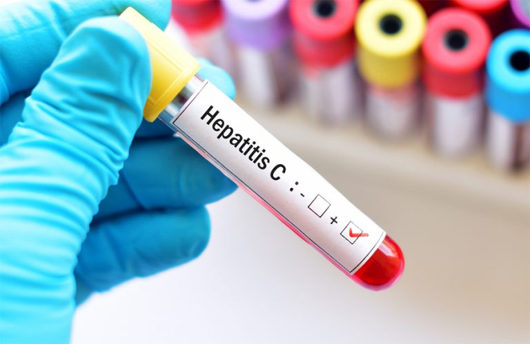 हेपाटाइटिस सी : कारण, लक्षण र उपचार