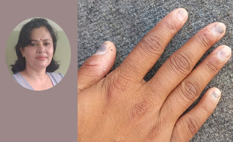 नङसम्बन्धी कस्ता कस्ता समस्या आउँछन् ? बच्न के गर्ने ?