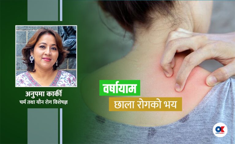 छाला चिलाउने, पोल्ने र सुन्निने समस्यामा के गर्ने ?