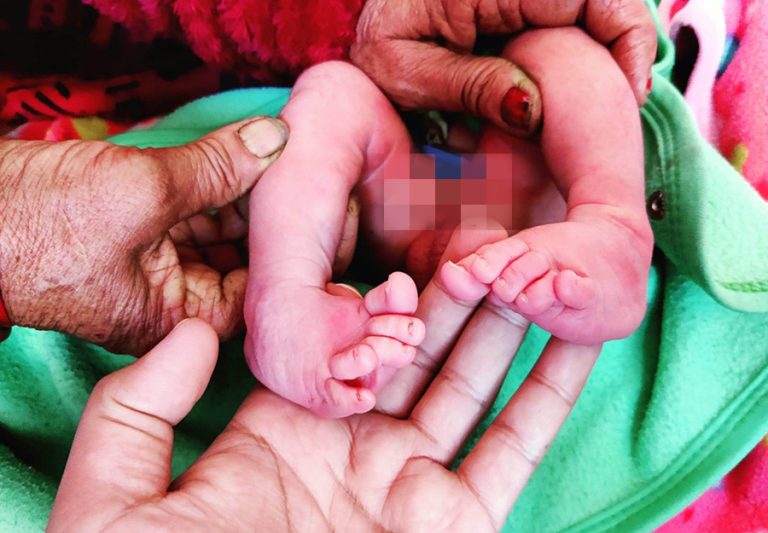 जन्मदै बाङ्गो खुट्टो भएको बच्चाको गुल्मी अस्पतालमा सफल उपचार