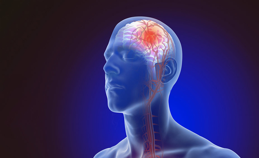 स्ट्रोकको उपचारमा किन न्युरो इन्टरभेन्सनल पद्धति प्रभावकारी मानिन्छ ?