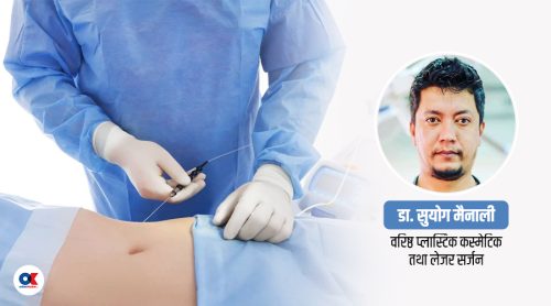 शरीरको बोसो हटाउने लाइपोसक्सन सर्जरी के हो ?