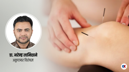 अकुपञ्चरलाई वैकल्पिक हैन, पूरक चिकित्साका रुपमा लिऔं