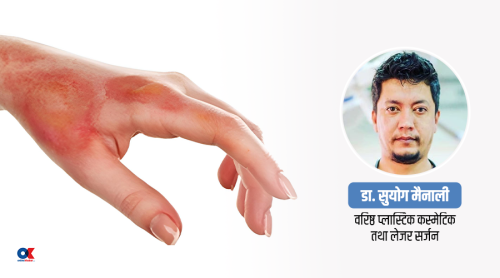 तातो तेलले पोले तुरुन्तै के गर्ने ?