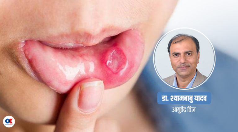 ओठ-मुखमा आएको खटिरा निको पार्ने घरेलु उपाय