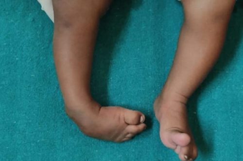 नर्भिक अस्पतालमा पेडियाट्रिक अर्थोपेडिक सेवा