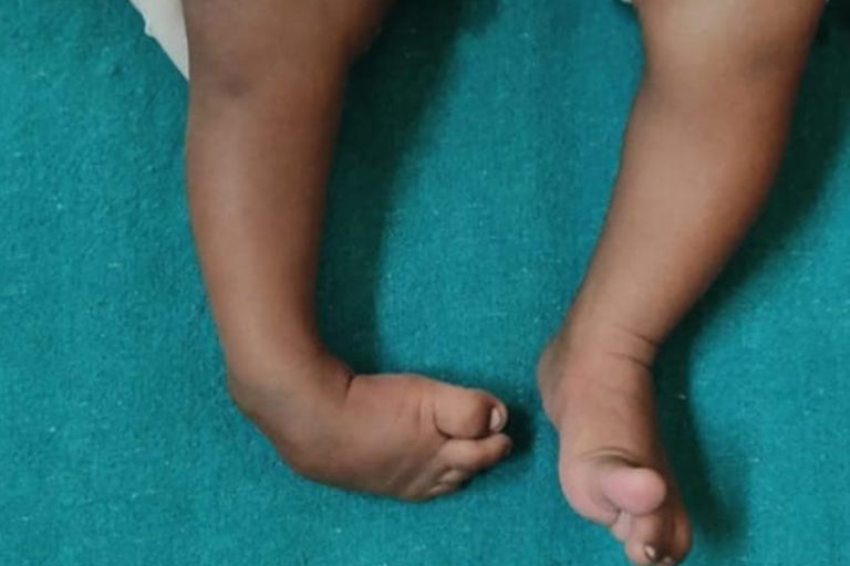 नर्भिक अस्पतालमा पेडियाट्रिक अर्थोपेडिक सेवा