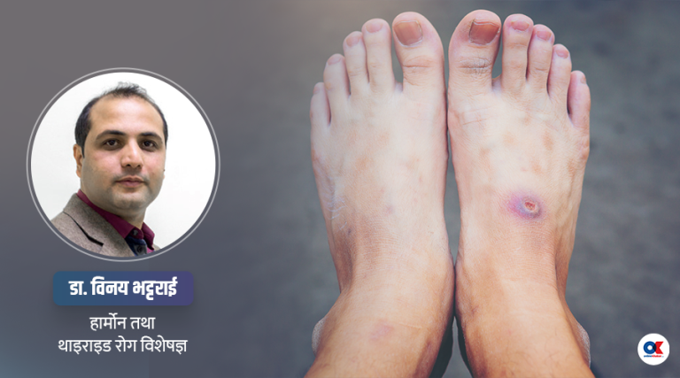 मधुमेहका बिरामीको खुट्टामा किन घाउ हुन्छ ?