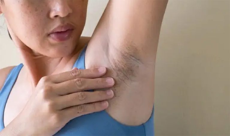 काखीको कालोपन हटाउने १० घरेलु उपाय