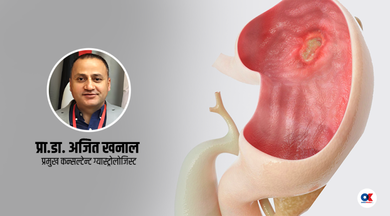 कसरी हुन्छ अल्सर, के छ उपचार ?