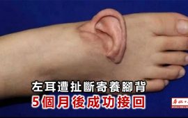 चिनियाँ युवतीले ५ महिनासम्म खुट्टामै पालिन् चुँडिएको आफ्नो कान !