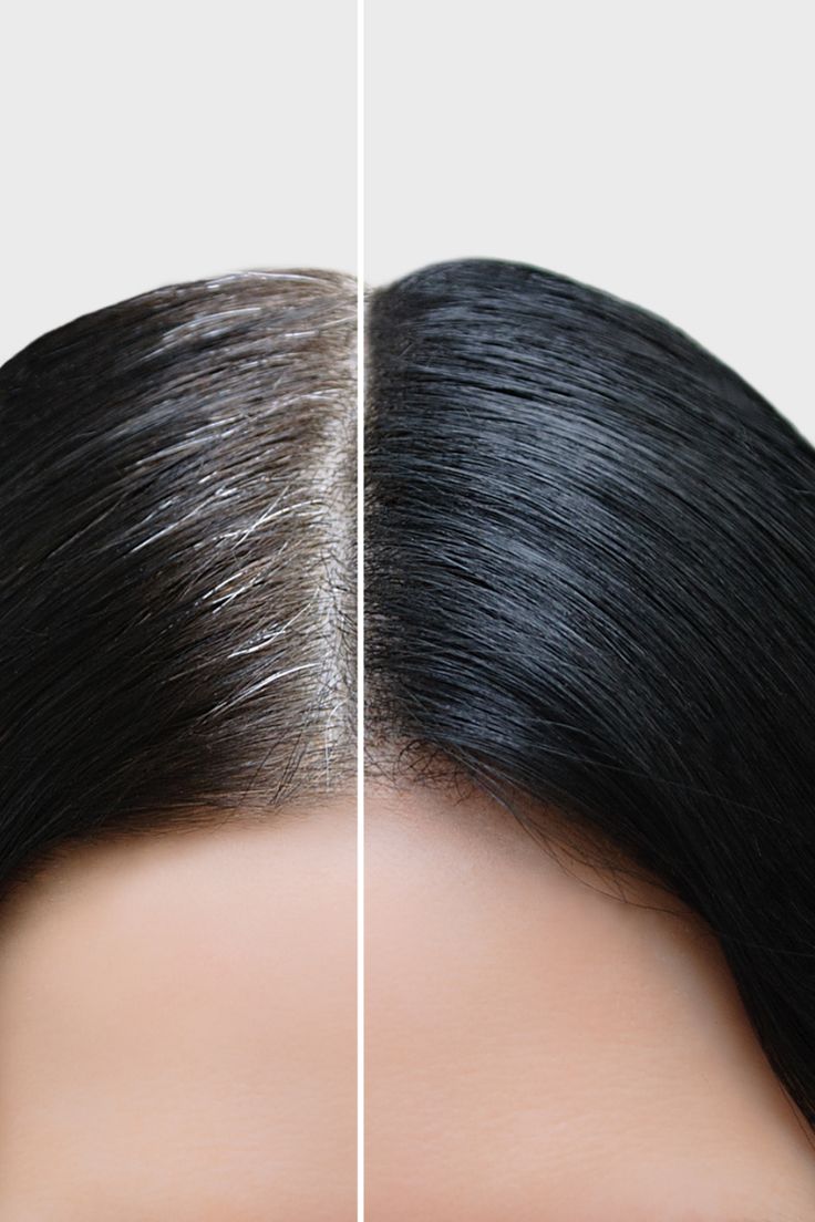 उमेर भन्दा अघि कपाल फुल्ने कारण