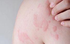 छाला चिलाउने मुख्य ६ कारण, चिलाउने समस्या रोक्न तत्काल के गर्ने ?