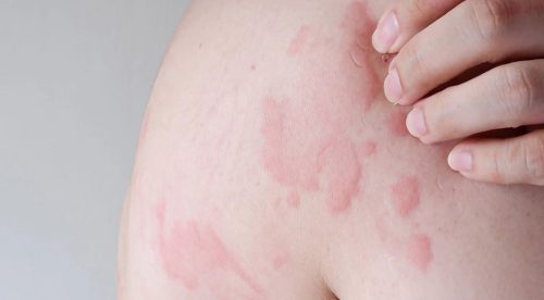 छाला चिलाउने मुख्य ६ कारण, चिलाउने समस्या रोक्न तत्काल के गर्ने ?