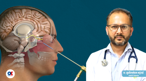 जीवन बचाउने ‘इन्डोस्कोपिक ब्रेन सर्जरी’ के हो  ? कुन अवस्थामा गरिन्छ ?