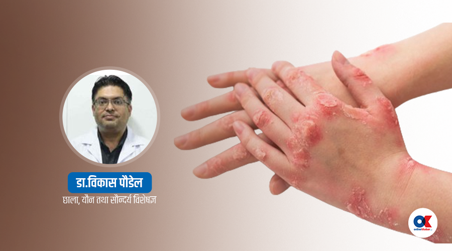 कुष्ठरोग : उन्मूलन घोषणा गरेको वर्षौं बित्यो, अझै किन छ नेपालमा ?