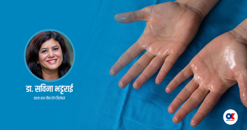 के हातमा पसिना आइरहनु कुनै रोगको संकेत हो ?