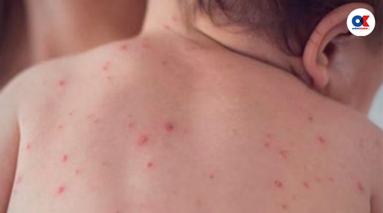 दादुराका ६७ बिरामी उपचारपछि घर फर्किए, २० जना आइसोलेसनमा