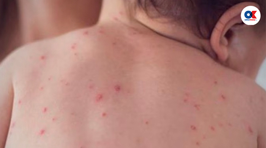 दादुराका ६७ बिरामी उपचारपछि घर फर्किए, २० जना आइसोलेसनमा