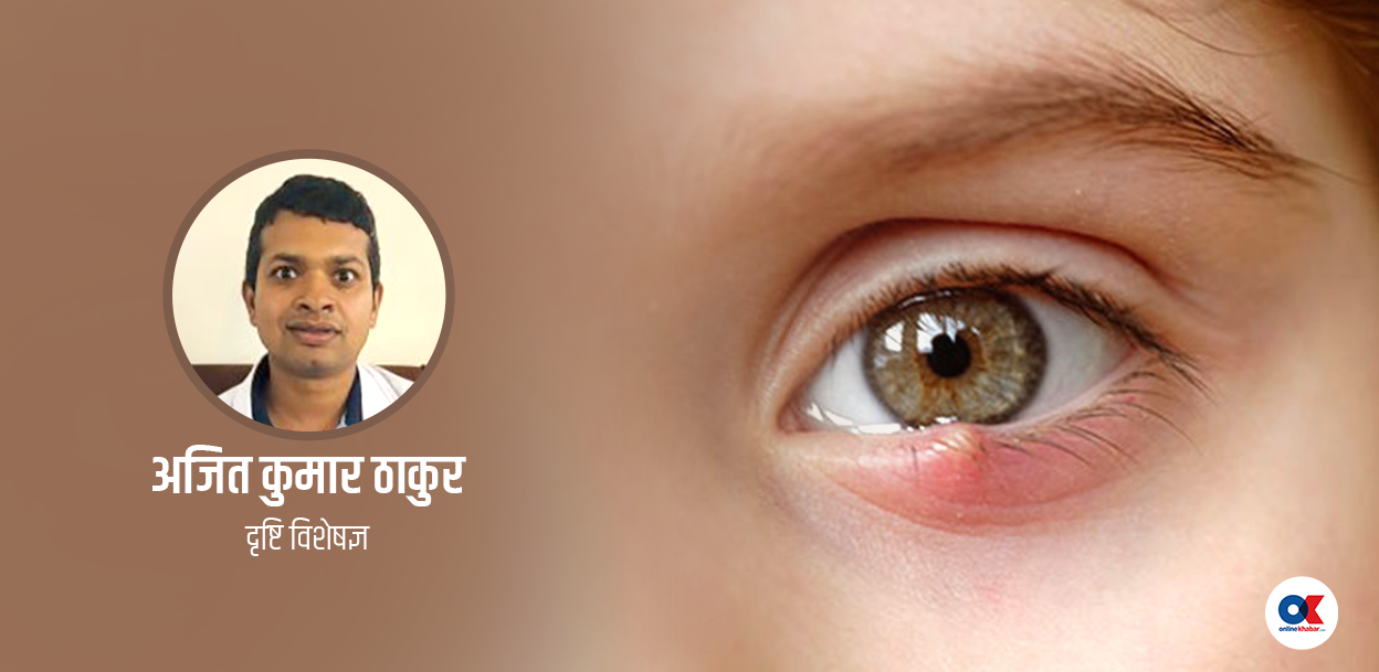 डेढो आँखा हुनु कुनै रोगको संकेत पनि हुन सक्छ, कसरी हुन्छ उपचार ?