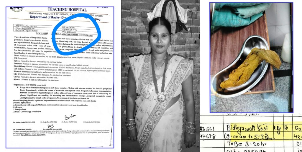 अप्रेसन गर्दा पेटभित्र स्पन्ज छुटेको आशंका : १५ महिनापछि महिलाको मृत्यु