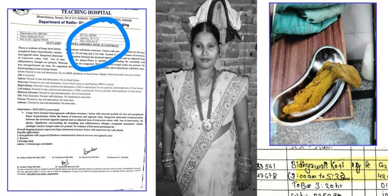 अप्रेसन गर्दा पेटभित्र स्पन्ज छुटेको आशंका : १५ महिनापछि महिलाको मृत्यु