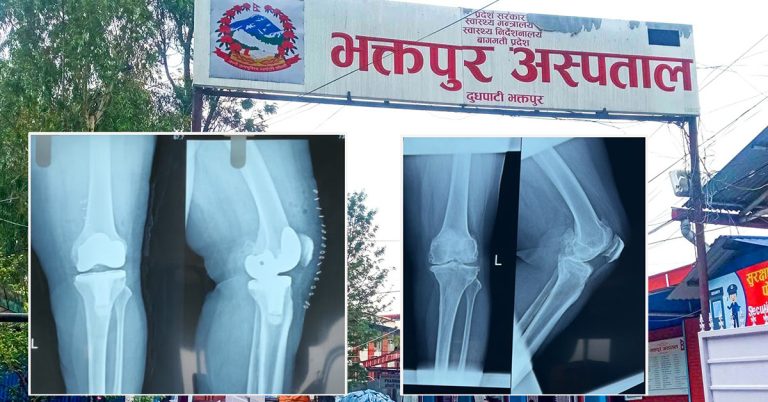 भक्तपुर अस्पतालमा पहिलो पटक घुँडाको जोर्नी प्रत्यारोपण शल्यक्रिया